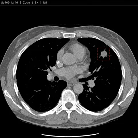 Chest CT scan (illustrative)
